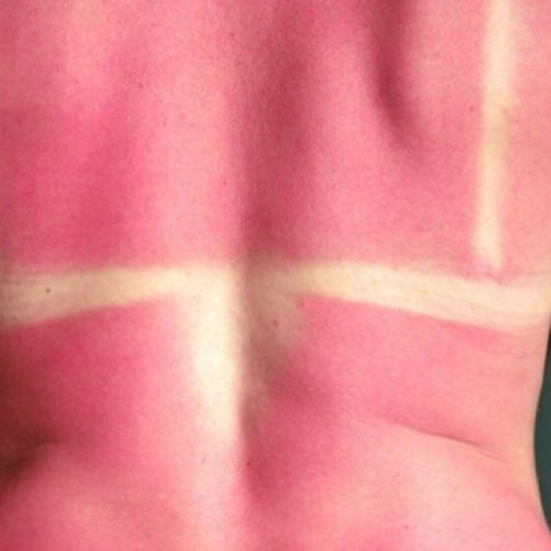 Sezonul arsurilor solare aduce riscuri medicale
